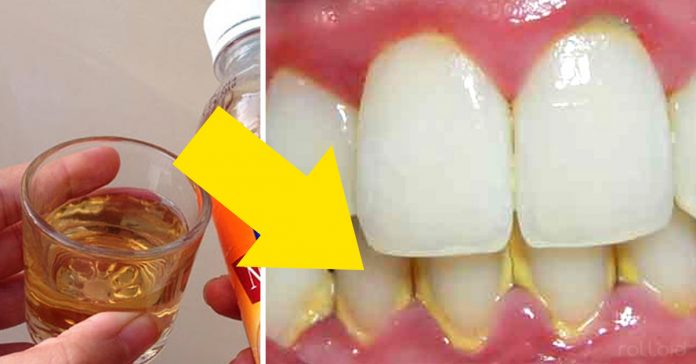 eliminar el sarro de tus dientes de forma natural